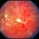Retinal AVM colour image